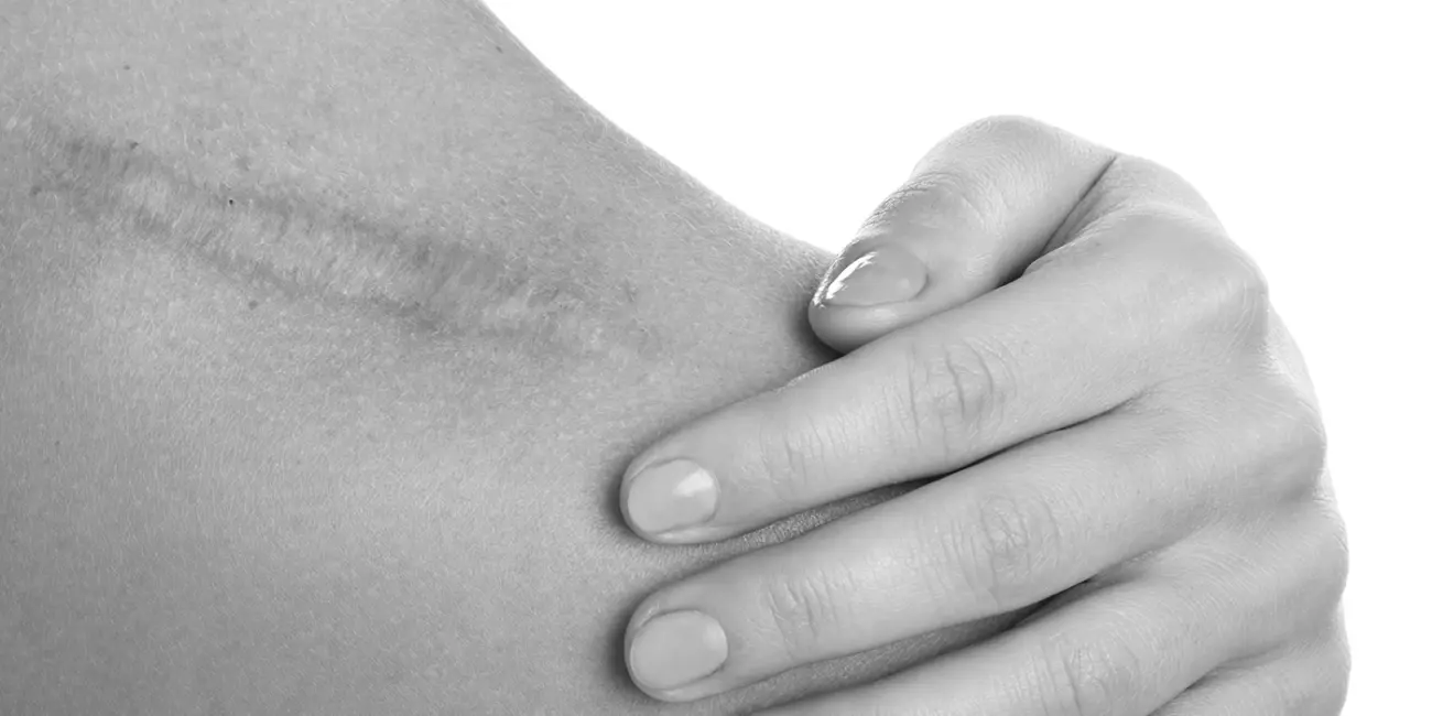 Narben-Svenja-Sanfte-Schoenheit-1-1300x650