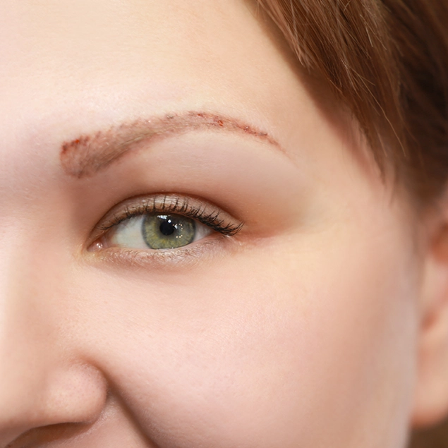 Removal-IQ Aesthetics in Rosenheim